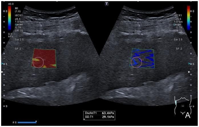This diagnostic image consists of side-by-side ultrasound frames demonstrating 2D Shear Wave Elastography (SWE) and Shear Wave Dispersion (SWD) of the liver in an intercostal view. The left panel shows a color-coded elastogram map overlaid on a B-mode image. The sample window is predominantly red, indicating high tissue stiffness, with a circular Region of Interest (ROI) marked 'T1'. The right panel displays a corresponding shear wave mapping, showing inhomogeneous blue shades representing elevated shear wave speed. Quantitative data at the bottom indicates a liver stiffness value (DschnT1) of 63.4 kPa with a standard deviation (SD.T1) of 29.1 kPa, findings consistent with advanced liver fibrosis or cirrhosis. System parameters displayed at the top-left include a Mechanical Index (MI) of 1.6 and a frame rate of 1.0 fps. A color scale on the far left correlates red with high stiffness (40.0 kPa) and blue with low stiffness (0.0 kPa). A schematic diagram in the lower right corner indicates the probe position on the patient's right abdomen.