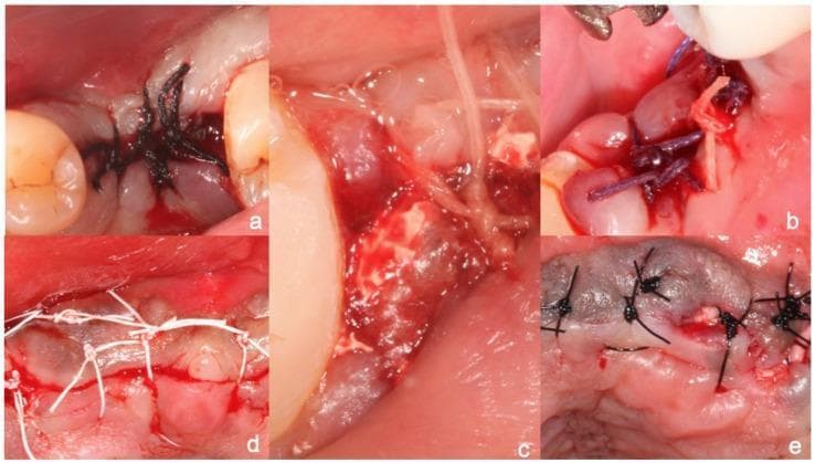 A composite of five clinical intraoral photographs (a–e) demonstrating different surgical suture materials used for wound closure in dental or maxillofacial surgery. Each panel illustrates specific material properties and knotting techniques: (a) Black braided silk suture showing a multifilament texture with multiple throws; (b) Violet-colored Vicryl (polyglactin 910), a coated synthetic absorbable suture; (c) Translucent gut suture, a natural collagenous material; (d) White PTFE (polytetrafluoroethylene) monofilament suture, characterized by its non-wicking, hydrophobic appearance and simple interrupted knots; (e) Dark-colored monofilament polyamide (nylon) suture. The images focus on tissue approximation, suture bite size, and the physical interaction between the thread and the oral mucosa. This visual guide serves as a pedagogical resource for identifying suture types by color, texture, and handling characteristics while highlighting clinical application in periodontal and surgical sites.