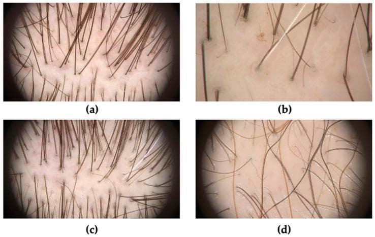 This composite of four clinical trichoscopy images (a-d) illustrates key diagnostic features of androgenetic alopecia (AGA) at various stages of progression. Image (a) demonstrates hair shaft heterogeneity (anisotrichosis), characterized by a significant variation in hair diameter, the loss of triple-hair follicular units, and the presence of yellow dots (follicular infundibula filled with sebum or keratin). Image (b) highlights the presence of short, thin, non-pigmented vellus hairs replacing terminal hairs. Image (c) shows early-stage AGA featuring peripilar signs, appearing as darkened, brownish-grey halos (perifollicular hyperpigmentation) around the hair shaft exit points. Image (d) illustrates late-stage AGA, marked by a severe reduction in hair density, the predominance of single-hair units over multiple-hair units, and numerous prominent yellow dots. These images are essential for the dermatological assessment of pattern hair loss, providing visual evidence of follicular miniaturization and characteristic scalp skin changes used to differentiate AGA from other forms of alopecia.