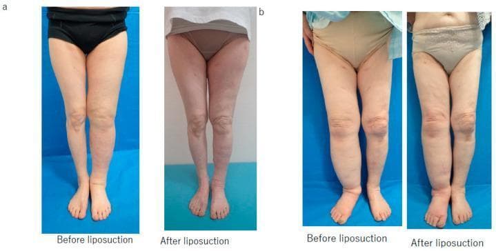 This clinical comparison chart presents two sets of 'before' and 'after' clinical photographs of lower extremity secondary lymphedema treated with suction-assisted lipectomy (liposuction). Panel (a) illustrates a successful clinical outcome in a 71-year-old woman with left lower limb lymphedema. The 'before' image shows significant edema-related enlargement of the left calf and ankle with loss of anatomical definition. The 'after' image, taken following 2000 mL fat removal and a dual compression regimen (stocking and bandage), shows a marked reduction in limb circumference and restoration of leg contour. Panel (b) depicts an unsuccessful result in a 78-year-old woman with right lower limb lymphedema. The 'before' image demonstrates substantial swelling throughout the right leg, particularly distal to the knee. The 'after' image, following 1800 mL fat removal and bandage-only compression, shows persistent limb hypertrophy and lack of significant volume reduction. The series serves as a clinical case study comparing the efficacy of different post-operative compression strategies in managing chronic lymphedema after lymphaticovenous anastomosis failure.
