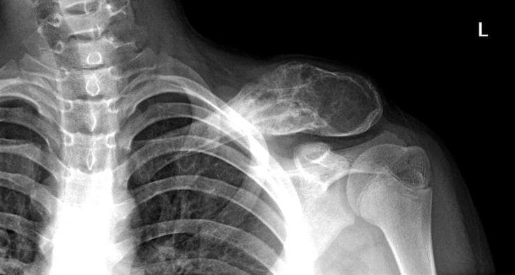 This diagnostic x-ray radiography displays an anteroposterior view of the left clavicle and shoulder region. The image demonstrates a large, aggressive osteolytic lesion primarily involving the distal half of the clavicle. Key radiological features include a 'moth-eaten' pattern of bone destruction and a lamellated (onion-skin) periosteal reaction, which are characteristic findings of highly aggressive primary bone tumors such as Ewing sarcoma. The lesion is expansile, causing significant enlargement and thinning of the cortical bone with focal disruption of the periosteum. Additionally, there is a prominent soft tissue mass or swelling overlying the affected bone segment, suggesting extraosseous extension of the pathology. The acromioclavicular and glenohumeral joints appear preserved. This clinical imaging is essential for medical students and radiology residents to recognize aggressive bone malignancies in pediatric or adolescent patients, emphasizing the importance of identifying specific periosteal reactions and bone destruction patterns in musculoskeletal oncology.