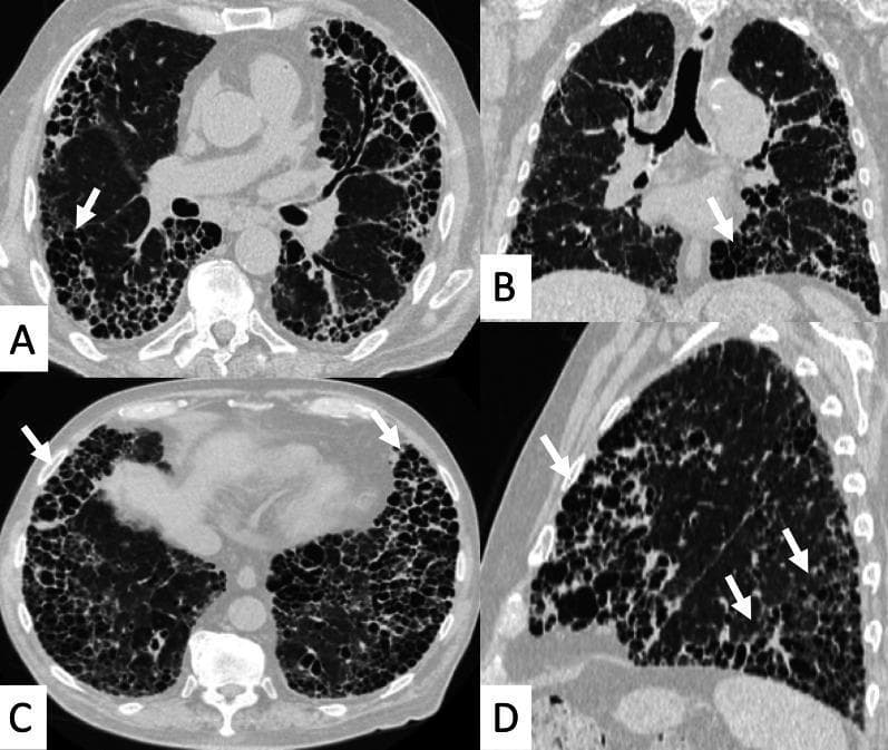 High-resolution computed tomography (HRCT) of the chest in axial (A, C), coronal (B), and sagittal (D) planes demonstrating advanced interstitial lung disease. The images show diffuse, extensive honeycombing involving more than 50% of the lung parenchyma. This finding is characterized by the 'exuberant honeycombing sign,' featuring hypertrophic, well-defined macrocystic spaces (white arrows) that are larger than those seen in typical honeycomb patterns. The cystic changes are most prominent in the peripheral and subpleural regions of both lungs, with a notable basal predominance. These findings represent a Usual Interstitial Pneumonia (UIP) pattern in the context of Rheumatoid Arthritis-associated Interstitial Lung Disease (RA-ILD). Associated features include marked architectural distortion and the absence of significant ground-glass opacities, indicating end-stage fibrotic disease.