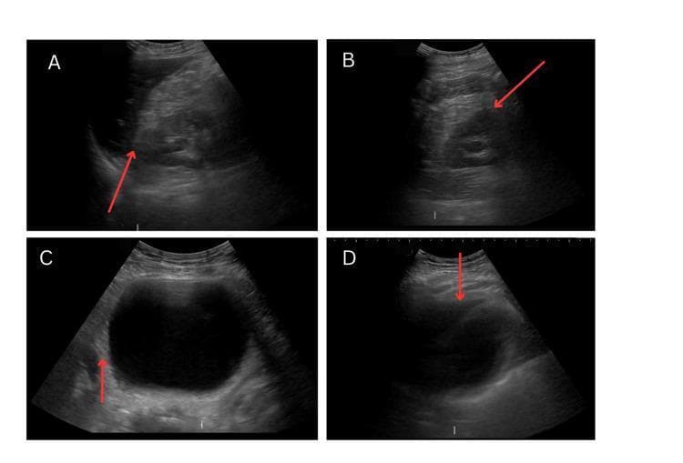 This diagnostic image series consists of four B-mode ultrasound frames representing a Focused Assessment with Sonography for Trauma (FAST) exam. Image A shows the right upper quadrant view, focusing on Morison’s pouch (the hepatorenal recess); red arrows indicate a clear interface between the liver and right kidney with no free anechoic fluid. Image B displays the left upper quadrant view, showing the splenorenal recess and the diaphragm interface, also devoid of fluid. Image C captures the pelvic view (suprapubic longitudinal or transverse), dominated by a large, well-circumscribed, anechoic urinary bladder; the red arrow points to the rectovesical space (in males) or pouch of Douglas (in females), which is negative for free fluid. Image D presents the subxiphoid or subcostal pericardial view, assessing the potential space between the visceral and parietal pericardium for effusion or tamponade, showing a negative result. Collectively, these images illustrate a normal FAST exam protocol used to rule out hemoperitoneum and hemopericardium in emergency clinical settings.
