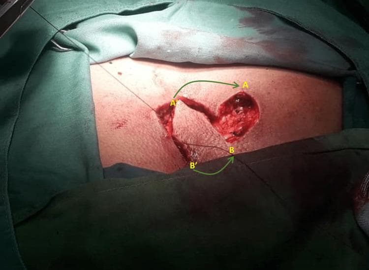 This clinical photograph captures an intraoperative view of a surgical procedure for pilonidal sinus disease (PSD) in the sacrococcygeal region. The image demonstrates the creation of a rotational 'swing flap' to reconstruct a surgical defect. A primary elliptical wound is visible where the pilonidal sinus was excised, exposing deep subcutaneous tissue and underlying fascia. Adjacent to this, a linear incision has been made to mobilize a vascularized skin flap. Annotated green arrows with labels A' to A and B' to B indicate the planned vector of transposition, showing how the mobilized tissue will be rotated to cover the primary excision site. The surgical field is surrounded by green sterile drapes. This visual highlights the technique of using local flap transposition rather than primary midline closure to reduce tension and move the scar away from the midline, which are key principles in preventing PSD recurrence. This material is intended for surgical residents and medical students studying plastic and reconstructive surgery techniques or colorectal management of sinus tracts.