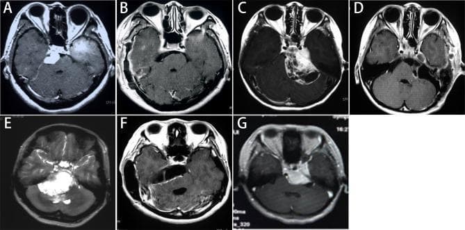 This composite of axial gadolinium-enhanced T1-weighted MRI scans illustrates various imaging classifications and postoperative outcomes for Petroclival Meningiomas (PCMs). The series compares preoperative tumor presentation (A, C, E, G) with postoperative results (B, D, F). Row 1 showcases the 'Petrous apex type' (A) with a left-sided mass near the temporal lobe, and its 'Simpson grade I' resection (B) showing complete removal via a subtemporal approach. The 'Tentorium type' (C) depicts a heterogeneous mass adjacent to the sigmoid sinus, with a 'Simpson grade II' resection (D) after a retrosigmoid approach. Row 2 highlights the 'Upper clivus type' (E), presenting a large midline mass involving the clivus, and the corresponding postoperative image (F) showing 'Simpson grade II' resection via an anterior sigmoid approach. Finally, image (G) demonstrates a 'Cavernous type' tumor involving the cavernous sinus and internal carotid artery region. The collection serves as an educational resource for neurosurgical planning, demonstrating how tumor location influences the choice of surgical approach (e.g., Kawase, retrosigmoid, subtemporal) and the achievable extent of resection.