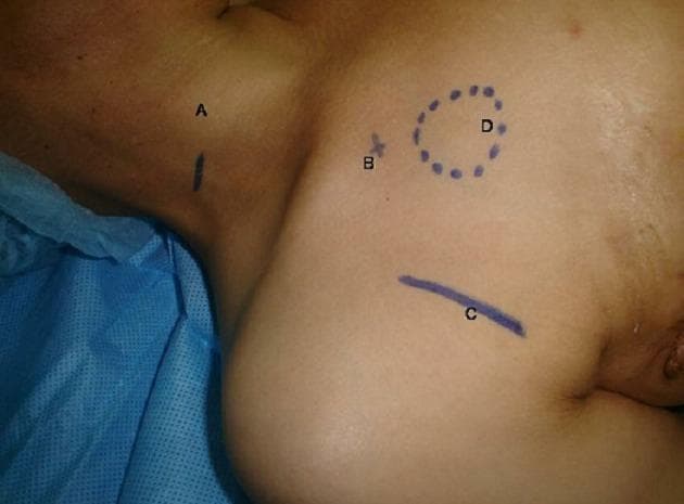 This clinical photograph displays preoperative surgical skin markings on a patient's right neck and upper chest area, identifying anatomical landmarks for central venous access and port-a-cath placement. The image features four distinct blue ink markings labeled A through D: 'A' is a vertical line on the lateral neck corresponding to the internal jugular vein; 'B' is a cross-mark (plus sign) at the infraclavicular region representing the subclavian vein entry point; 'C' is a horizontal curved line near the deltopectoral groove indicating the cephalic vein dissection site; and 'D' is a dotted circular outline on the superior-lateral chest wall marking the planned subcutaneous pocket for the implantable chamber. These markings illustrate the topographic anatomy and surgical planning for various venous access techniques, including percutaneous puncture and surgical cut-down. The content is relevant for surgical oncology, anesthesia, and interventional radiology training regarding the placement of long-term vascular access devices.