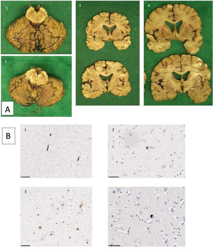 This composite image presents neuropathological findings from two siblings with Parkinson’s disease. Panel A contains macroscopic brain specimens: images 1 and 2 show the substantia nigra and cerebellum with evidence of depigmentation; images 3 and 4 display coronal sections through the basal ganglia and cortical regions, demonstrating mild ventricular enlargement and cortical atrophy. Panel B presents microscopic immunohistochemistry for alpha-synuclein pathology. Images B1 and B3 illustrate the substantia nigra, highlighting dark-stained Lewy neurites (thread-like processes) and classical Lewy bodies (rounded cytoplasmic inclusions). Images B2 and B4 show cortical sections containing cortical Lewy bodies, which appear as less defined, round inclusions within neuronal soma. The pathology demonstrates the characteristic widespread distribution of alpha-synuclein aggregates in genetic or familial Parkinson’s disease, involving both brainstem and cortical regions. This visual resource is intended for educational use in neurology and pathology to distinguish between macroscopic neurodegeneration and microscopic proteinaceous inclusions.