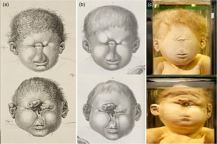 This composite image illustrates severe craniofacial malformations, specifically holoprosencephaly manifestations, comparing historical medical art with preserved pathology specimens. The image is divided into three columns: (a) 19th-century copperplate engravings, (b) lithographs, and (c) color photographs of preserved wet specimens. The top row depicts cyclopia, characterized by a single, centrally located eye (synophthalmia) in a single orbital cavity and an absent nose (arrhinia) with a visible philtrum and mouth. The bottom row demonstrates a more complex cephalic malformation where a single orbital opening is situated below a tubular, fleshy appendage known as a proboscis, which is located in the supraorbital region. These comparisons highlight the evolution of medical illustration from detailed artistic interpretation to modern specimen preservation. The visual focus is on midline facial defects, dysmorphic ears, and the anatomical variations of the proboscis and eye fusion, providing a historical and clinical perspective on teratological study and dysmorphology.