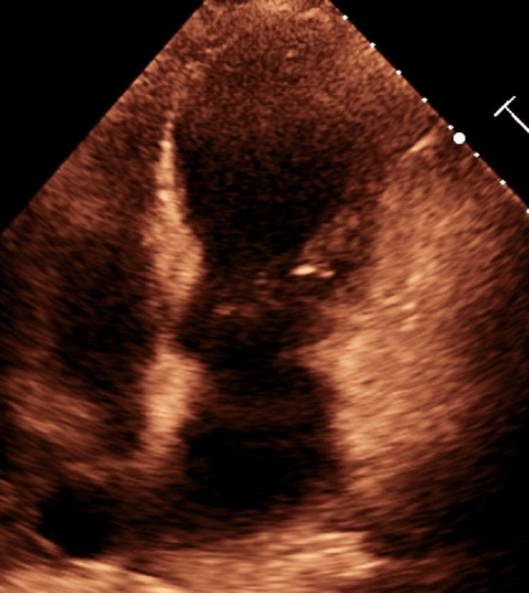 A diagnostic 2D echocardiogram image in an apical view, showing a sepia-toned cross-section of the human heart. The primary finding is characteristic of Takotsubo Cardiomyopathy (TCM), specifically demonstrating apical ballooning of the left ventricle (LV). The image displays a distinct morphological abnormality where the apical and mid-ventricular regions are dilated and rounded, creating a shape reminiscent of a Japanese octopus trap ('tako-tsubo'). In contrast, the basal segments of the left ventricle appear relatively preserved in their diameter. This visual pattern represents regional wall motion abnormalities, typically associated with apical akinesis or dyskinesis despite the absence of obstructive coronary artery disease. This diagnostic image is essential for educating medical professionals on the pathognomonic visual signs of 'Broken Heart Syndrome,' emphasizing the disparity between hypercontractile basal segments and the ballooned, non-contractile apex.
