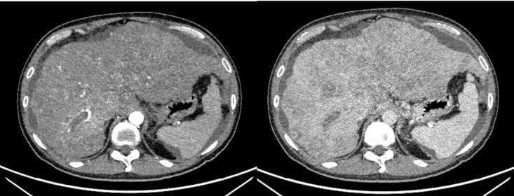 Two axial slices from a preoperative abdominal Computed Tomography (CT) scan demonstrating advanced liver pathology. The liver is significantly enlarged (hepatomegaly) with a highly irregular, nodular contour consistent with decompensated cirrhosis. The hepatic parenchyma exhibits diffuse, heterogeneous attenuation with multiple ill-defined, hypo- and hyper-dense regions suggestive of multifocal hepatocellular carcinoma (HCC). Large, bulky lesions distort the normal hepatic architecture, particularly in the right lobe and dome. Evidence of portal hypertension is present, including prominent perihepatic ascites (fluid accumulation) visible as a low-density rim between the liver surface and the abdominal wall. The stomach is visible on the right side of the images (patient's left), appearing partially distended. Posteriorly, the abdominal aorta and spinal column are well-visualized. This diagnostic imaging highlights the typical radiographic presentation of extensive HCC arising in the context of viral hepatitis-induced cirrhosis before surgical intervention.