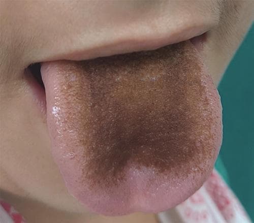 Clinical photograph of the human oral cavity showing the dorsal surface of the tongue. The image demonstrates Lingua Villosa Nigra, also known as black hairy tongue. There is a prominent, well-demarcated area of dark brown to blackish discoloration concentrated on the posterior and central dorsal regions, sparing the lateral borders and the tip. Morphologically, the filiform papillae exhibit significant hypertrophy and elongation, creating a distinctively textured, carpet-like or 'hairy' appearance. This condition is a benign clinical finding often associated with antibiotic use (such as linezolid), poor oral hygiene, or smoking, resulting from the accumulation of keratin and pigment-producing bacteria on the elongated papillae. The surrounding oral mucosa and lips appear healthy, providing a clear contrast to the central pathology. This image is used in medical education to illustrate drug-induced side effects and dermatological manifestations of the oral mucosa.