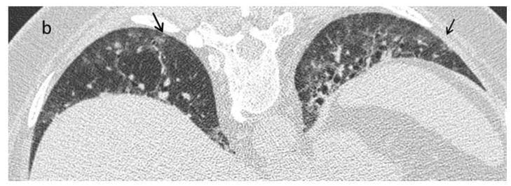 This diagnostic image is an axial High-Resolution Computed Tomography (HRCT) scan of the lung bases in a 42-year-old female patient with systemic sclerosis (SSc). The image demonstrates early-stage interstitial lung disease (ILD) characterized by subtle, patchy ground-glass opacities (GGO), indicated by black arrows. These opacities are primarily distributed in the peripheral and subpleural regions of both lungs. The ground-glass appearance is defined by a hazy increase in lung attenuation that does not obscure the underlying bronchovascular structures. Associated findings include mild reticular patterns and slight interlobular septal thickening within the affected areas. The persistence of these findings in a prone position scan (as indicated by the clinical context) suggests a non-specific interstitial pneumonia (NSIP) pattern rather than gravity-dependent atelectasis. This visual provides an educational example of the early pulmonary manifestations of connective tissue disease-associated ILD, emphasizing the importance of HRCT in detecting early interstitial alterations that may precede extensive fibrosis or honeycombing.