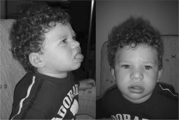 This clinical photograph consists of a lateral profile (left) and a frontal view (right) of a 16-month-old child exhibiting dysmorphic features characteristic of Angelman syndrome. The patient displays a wide nasal bridge, low-set ears, and a wide mouth with notably thick lips. A key clinical finding illustrated is macroglossia with a protruding tongue (tongue thrust), visible in both views but most prominent in the profile. The facial structure is rounded, and the patient has distinctive curly hair. This image serves as a clinical reference for the phenotypic manifestations of Angelman syndrome (AS) resulting from paternal uniparental disomy (UPD) of chromosome 15. The photograph is an educational resource for medical students and geneticists to identify craniofacial markers of genomic imprinting disorders, emphasizing the characteristic 'happy puppet' facies often associated with the condition.