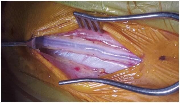 This clinical photograph captures a 'no-touch' saphenous vein graft (SVG) harvest during a surgical procedure, likely for coronary artery bypass grafting (CABG). The central focus is the saphenous vein, a long, bluish-white tubular structure characterized by a smooth surface with subtle longitudinal striations. Surrounding the vein is a generous margin of perivascular tissue (PVT), which appears pinkish, moist, and contains visible connective tissue strands and small vasa vasorum. This 'no-touch' technique preserves the PVT to improve long-term graft patency. The surgical field is exposed using stainless steel retractors; a self-retaining retractor with metal tines laterally displaces the skin and subcutaneous fat (covered by orange surgical drapes), while a blunt hand-held retractor provides further exposure on the left. The image illustrates careful surgical dissection designed to minimize direct trauma to the vessel wall by maintaining the native adventitia and surrounding fat.