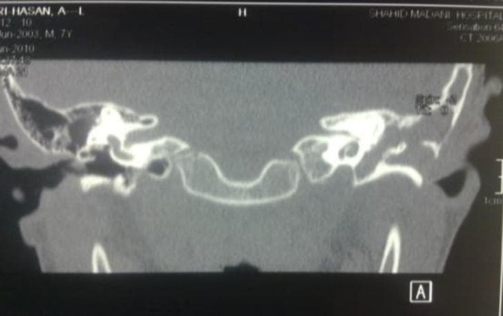This diagnostic image is a coronal Computed Tomography (CT) scan of the temporal bones focusing on the middle ear and mastoid air cell systems. The scan demonstrates significant bilateral pathology characterized by extensive bony erosion and the loss of normal mastoid air cell septation, a condition described as automastoidectomy. The middle ear cavities and enlarged mastoid regions are opacified by heterogeneous soft tissue density material, consistent with congenital cholesteatoma. Key visible landmarks include the ossicular chain, which appears indistinct or eroded, and the tegmen tympani. On the right side, measurements are visible indicating clinical assessment of the bony structures. The anatomical context relates to a rare case of a first branchial cleft fistula opening into the middle ear through the zygomatic root. This visual is significant for otolaryngology and pediatric radiology, illustrating the advanced bony remodeling and middle ear obliteration associated with congenital ear malformations and chronic cholesteatoma.