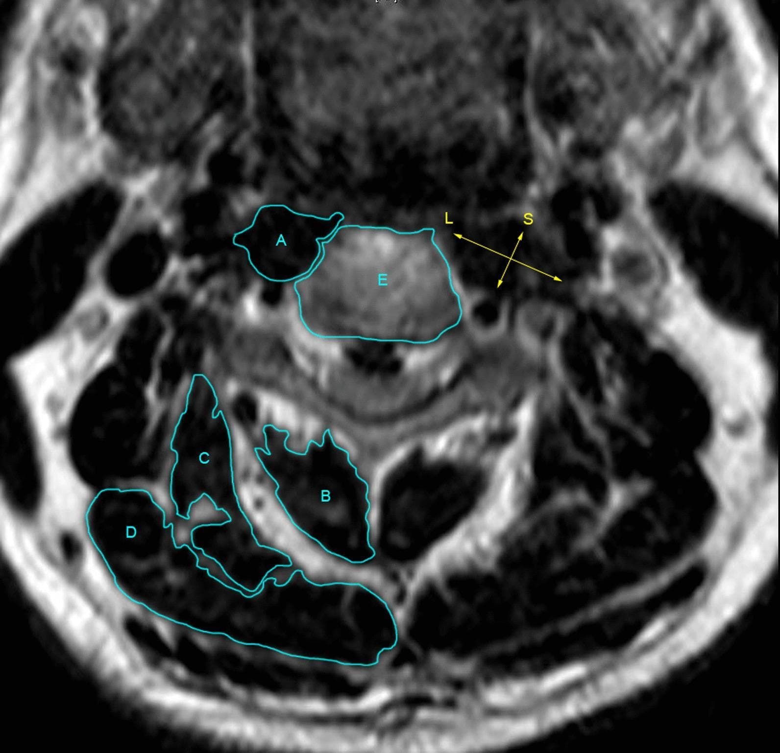 This diagnostic image is an axial T2-weighted MRI scan of the cervical spine, serving as a measurement diagram for cervical musculature. The central vertebral body is labeled 'E'. To its anterior and medial aspect, the cervical longus muscle is outlined and labeled 'A'. Posterior to the vertebral column, the cervical extensor muscles are delineated: 'B' identifies the combined multifidus and semispinalis cervicis muscles; 'C' denotes the splenius cervicis and semispinalis capitis; and 'D' represents the splenius capitis. Yellow arrows illustrate the methodology for calculating the Ratio of Long and Short diameter line (RLS) of the cervical longus muscle. The 'L' arrow represents the longest diameter, while the 'S' arrow represents the shortest diameter, intersecting to perform a 'dichotomy cutting' of the muscle's cross-sectional area. This imaging is clinically significant for evaluating muscle morphology and atrophy, particularly in the context of preoperative and postoperative assessments for anterior cervical surgery. The target audience includes radiology and orthopedics specialists studying cervical spinal anatomy and surgical outcomes.