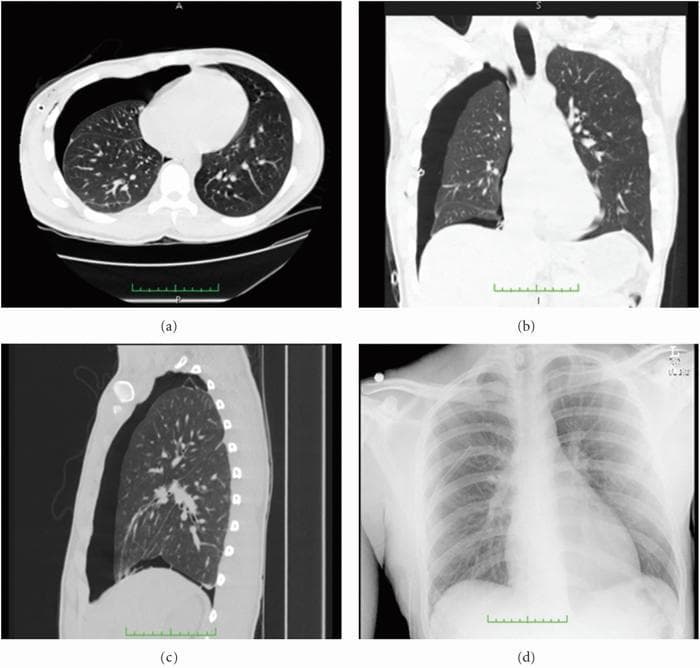 This composite educational image illustrates a moderate-to-large pneumothorax using multiple imaging modalities. The panel includes three Computed Tomography (CT) scans and one posteroanterior chest X-ray (CXR) for comparative diagnostic analysis. (a) Axial CT slice shows the transverse cross-section, clearly demonstrating a large air-filled pleural space in the right hemithorax with resulting lung collapse and visualization of the visceral pleural line. (b) Coronal CT provides a frontal orientation, highlighting the vertical extent of the pneumothorax and the displacement of the lung towards the mediastinum. (c) Sagittal CT offers a lateral perspective, showing the anterior-posterior depth of the air collection. (d) The corresponding chest X-ray displays the same pathology but with reduced sensitivity; while the lung field appears hyperlucent, the fine anatomical detail of the lung parenchyma and the precise pleural separation are less distinct than in the CT views. This comparison emphasizes the superior capability of CT in localized pneumothorax detection and volumetric measurement, showing detailed bronchial and vascular structures within the remaining functional lung tissue.