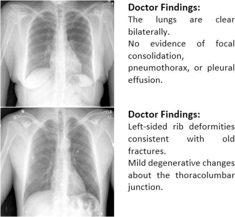 This diagnostic image provides a comparison of two posterior-anterior (PA) chest radiographs accompanied by their respective clinical findings. The upper panel displays a normal chest X-ray illustrating clear lung fields bilaterally. There is a notable absence of focal consolidation, pneumothorax, or pleural effusion, representing a standard baseline for pulmonary health. The lower panel demonstrates a chest radiograph with skeletal abnormalities, specifically identifying left-sided rib deformities suggestive of chronic or healed fractures. Additionally, it highlights mild degenerative changes located at the thoracolumbar junction of the spine. The visual comparison serves as an educational tool for differentiating between normal thoracic anatomy and common musculoskeletal findings such as old rib trauma and spinal degeneration in the context of diagnostic radiology. Key educational concepts include the identification of clear lung parenchyma versus the recognition of extrapulmonary skeletal variations.