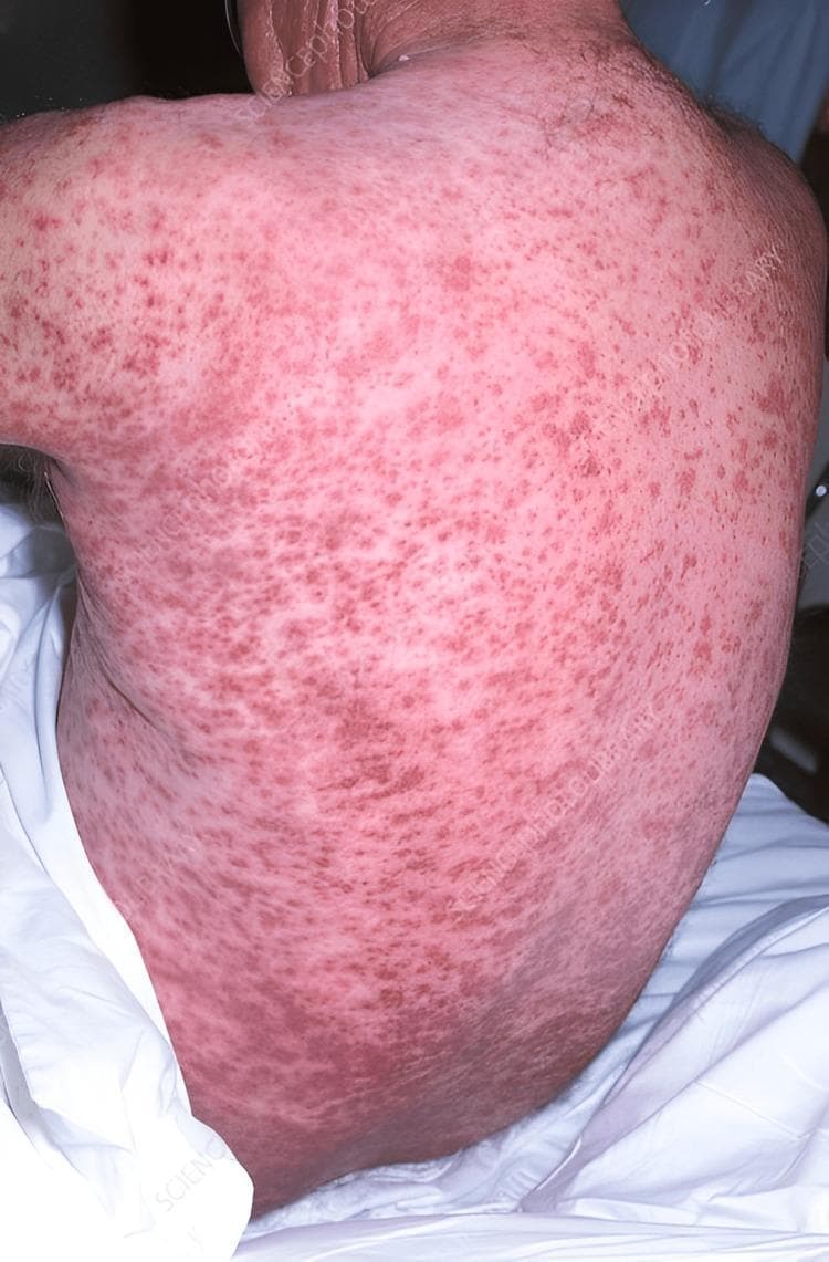 This clinical photograph displays the posterior torso of a patient exhibiting a widespread, confluent purpuric rash. The skin is densely populated with numerous non-blanching hemorrhagic lesions that vary in morphology. Smaller, pinpoint red lesions consistent with petechiae are visible, particularly on the upper back and shoulders. These lesions coalesce in the mid-to-lower back regions into larger, irregular macules and patches of deep red to purple discoloration, characteristic of purpura. The underlying background skin shows a generalized erythematous or sallow pinkish tone, suggesting systemic inflammation or vascular involvement. The extensive and symmetrical distribution across the back is clinically significant for evaluating systemic conditions such as severe malnutrition (e.g., Vitamin C deficiency/scurvy), vasculitis, or hematological disorders. This visual is intended for medical students and clinicians to recognize the cutaneous manifestations of systemic disease and differentiate between petechiae and palpable or non-palpable purpura.