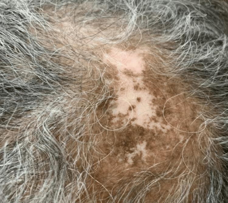 This clinical photograph shows a close-up view of the scalp demonstrating a healed lesion of discoid lupus erythematosus (DLE). The primary finding is a large, irregularly shaped patch of cicatricial (scarring) alopecia characterized by significant hair thinning and permanent hair loss. The affected skin exhibits prominent pigmentary changes, including central hypopigmentation (leukoderma) interspersed with mottled, dark brown hyperpigmented macules, creating a 'salt-and-pepper' appearance. The surrounding scalp skin appears normally pigmented but shows age-related graying (canities) of the remaining hair. The texture within the lesion appears smooth and atrophic, consistent with post-inflammatory scarring from chronic cutaneous lupus. There are no signs of active inflammation such as erythema, scaling, or follicular plugging, indicating the lesion is currently in a quiescent or healed state. This visual is representative of the long-term sequelae of DLE in patients with Systemic Lupus Erythematosus (SLE), highlighting the importance of early intervention to prevent permanent follicular destruction and disfiguring dyschromia.