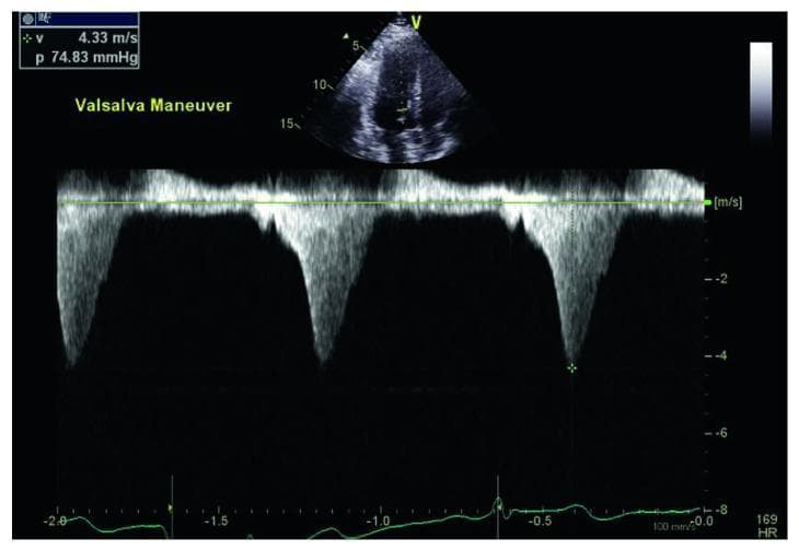 This diagnostic image is a spectral continuous-wave Doppler echocardiogram from a patient performing a Valsalva maneuver. The top portion displays a 2D apical four-chamber view of the heart with the Doppler cursor positioned across the left ventricular outflow tract (LVOT). The central spectral tracing shows high-velocity systolic flow directed away from the transducer, appearing as dense, negative, ‘dagger-shaped’ envelopes. Quantitative data in the upper-left corner records a peak velocity (v) of 4.33 m/s and a corresponding peak pressure gradient (p) of 74.83 mmHg, calculated via the Bernoulli equation. The spectral morphology—specifically the late-systolic peaking—is characteristic of dynamic LVOT obstruction, commonly seen in hypertrophic cardiomyopathy (HCM). A simultaneous electrocardiogram (EKG) trace at the bottom provides temporal correlation with the cardiac cycle. This visualization demonstrates how provocative maneuvers like the Valsalva maneuver can exacerbate dynamic obstruction by decreasing preload and ventricular volume.