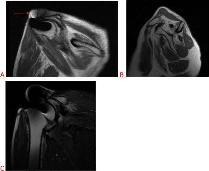This composite figure presents three MRI views of a right shoulder, illustrating end-stage rotator cuff arthropathy and its secondary manifestations.