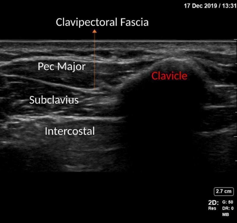 This diagnostic image is a high-frequency linear ultrasound scan of the anterior chest wall, specifically showcasing the anatomical landmarks for a Clavipectoral Fascia Block (CPB). The scan displays a layered cross-section of musculoskeletal structures. Superficially, the Pectoralis Major (Pec Major) muscle appears as a hypoechoic band. Deep to this, the Clavipectoral Fascia is identified as a hyperechoic interface separating the pectoralis major from the underlying Subclavius muscle. In the deeper field, hypoechoic Intercostal muscles are visible. To the right of the muscular layers, the Clavicle is presented as a prominent, hyperechoic convex surface that produces a distinct posterior acoustic shadow, obscuring deeper structures. This imaging provides clinical guidance for regional anesthesia, allowing for the precise identification of the fascial plane where local anesthetic is typically deposited to manage pain related to clavicular fractures or upper thoracic surgeries.