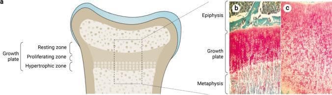 This composite educational resource illustrates the histological and anatomical characteristics of the human growth plate (physis) in healthy and rachitic states. Panel (a) is an anatomical diagram of a long bone end, labeling the growth plate zones: resting, proliferating, and hypertrophic. Panels (b) and (c) present histological comparison images, likely utilizing Goldner's trichrome or similar staining.
Panel (b) demonstrates a healthy growth plate with a highly organized transition from the epiphysis to the metaphysis. Key features include organized columns of chondrocytes, a well-defined zone of provisional calcification (red-pink staining), and mineralized bone (turquoise staining) at the metaphyseal border.
Panel (c) depicts a rachitic growth plate, showing significant pathological changes characteristic of rickets. There is a marked increase in the longitudinal width of the physis, a loss of the orderly columnar arrangement of chondrocytes, and a persistent, expanded zone of hypertrophic chondrocytes. The dominant red-pink staining indicates an accumulation of unmineralized cartilage matrix, reflecting impaired chondrocyte apoptosis and defective mineralization. This visual comparison highlights the skeletal manifestations of disturbances in calcium and phosphate homeostasis.