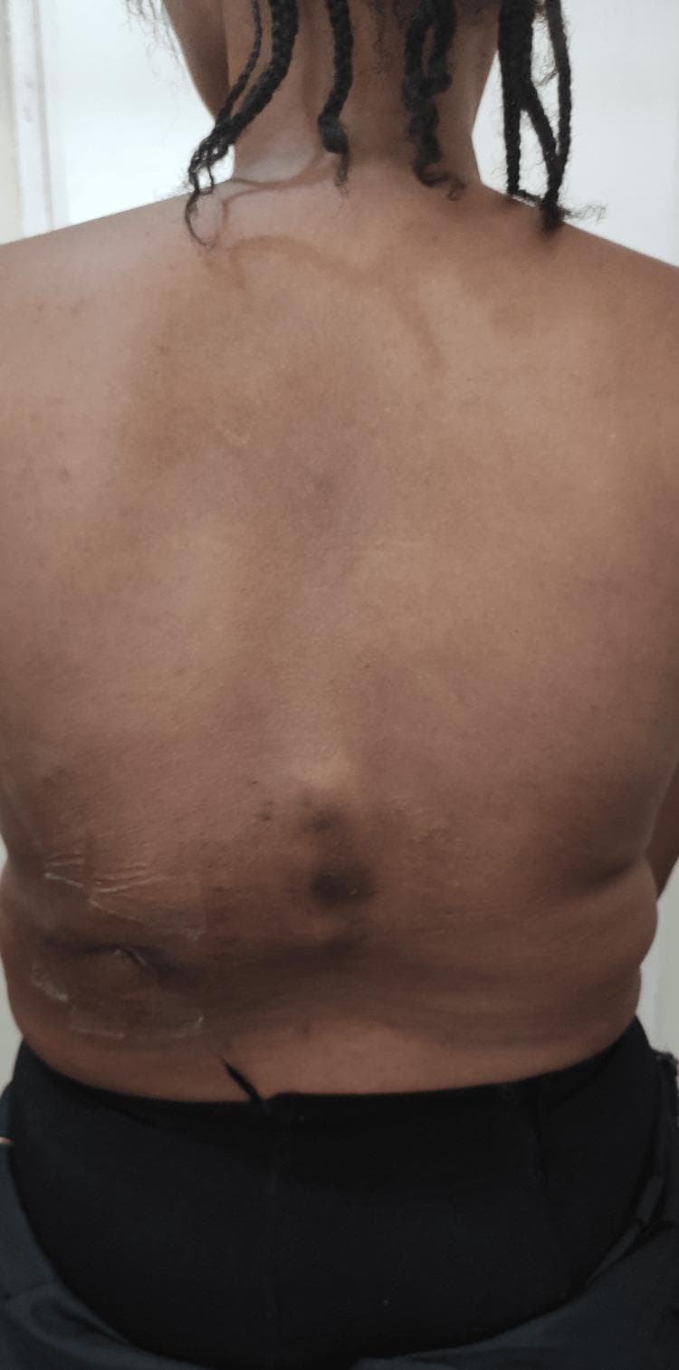 This clinical photograph displays the posterior view of a patient's back, focusing on significant spinal and cutaneous abnormalities. The primary musculoskeletal finding is a prominent thoracolumbar gibbus, a localized kyphotic deformity manifesting as a sharp posterior protrusion in the lower thoracic/upper lumbar region. Dermatological assessment reveals a visible sinus scar located on the left flank/waistline area, surrounded by hyperpigmented, darkened skin. Additional non-specific hyperpigmented patches are scattered across the mid-back region. The combination of a gibbus deformity and a chronic sinus scar is highly characteristic of Pott's disease (spinal tuberculosis), which typically involves vertebral destruction leading to spinal collapse and potential cold abscess formation with secondary skin involvement. This image serves as a teaching tool for recognizing physical manifestations of chronic spinal infections and structural spinal deformities in clinical practice.