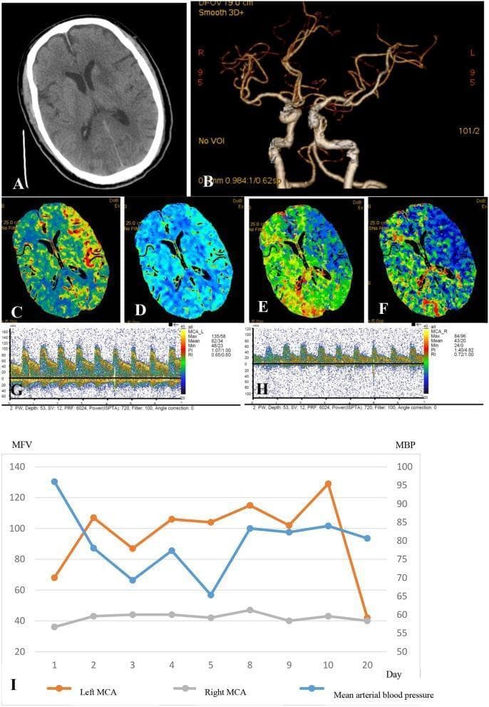 A multi-panel medical image illustrating a case of cerebral hyperperfusion syndrome following mechanical thrombectomy for acute ischemic stroke. Panel (A) is a non-contrast axial CT scan showing a hypodense infarct core in the left perforating middle cerebral artery (MCA) territory. Panel (B) is a CT angiography (CTA) reconstruction demonstrating patent left internal carotid artery (ICA) and MCA post-recanalization. Panels (C-F) present Computed Tomography Perfusion (CTP) maps including Cerebral Blood Flow (CBF), Cerebral Blood Volume (CBV), Mean Transit Time (MTT), and Time to Peak (TTP), highlighting increased CBF and CBV with decreased MTT in the left MCA territory relative to the infarct core. Panels (G-H) show Transcranial Doppler (TCD) waveforms comparing the left and right MCA; the left side demonstrates significantly higher peak systolic velocities and mean flow velocities. Panel (I) is a longitudinal line graph tracking mean flow velocity (MFV) for both MCAs alongside mean arterial blood pressure (MBP) over a 20-day period, documenting the management of hyperperfusion through blood pressure control.