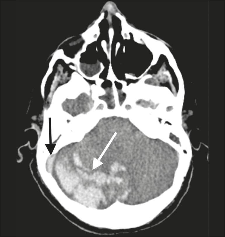 Non-contrast axial brain CT scan focusing on the posterior fossa. The image demonstrates a heterogeneous hyperdense area indicative of a hematoma (white arrow) located within the cerebellar vermis and the right cerebellar hemisphere. Furthermore, a focal hyperdensity is observed within the right sigmoid and transverse sinuses (black arrow), characteristic of the 'dense sinus sign.' This finding is highly suggestive of cerebral venous sinus thrombosis (CVST) resulting in secondary venous hemorrhagic infarction within the cerebellum. The image illustrates the radiological correlation between dural venous sinus occlusion and subsequent parenchymal hemorrhage. Clinical relevance includes the diagnosis of stroke complications in the context of hypercoagulable states, such as those observed in systemic inflammatory or viral conditions like COVID-19. This diagnostic image is intended for neurology and radiology students to identify signs of dural sinus thrombosis and associated hemorrhagic changes.