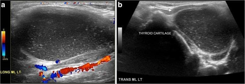 This dual-panel ultrasound image displays a thyroglossal duct cyst in the anterior neck. Panel (a) is a long-axis grayscale ultrasound with color Doppler showing a well-circumscribed, hypoechoic, oval structure. The interior contains numerous tiny, hyperechoic foci, consistent with proteinaceous or inflammatory debris. The color Doppler overlay confirms the absence of internal vascularity, while posterior acoustic enhancement (through transmission) is visible, confirming the cystic nature of the mass. Panel (b) shows a transverse grayscale ultrasound at the midline (ML LT), identifying the lesion's paramidline position. The cyst is located adjacent to the hyperechoic thyroid cartilage and is positioned deep to the strap muscles (indicated by the white arrow). This appearance is characteristic of an infrahyoid thyroglossal duct cyst, with internal complexity suggesting a history of prior infection or high protein content. The imaging is diagnostic for identifying midline congenital neck masses and differentiating them from solid lesions.