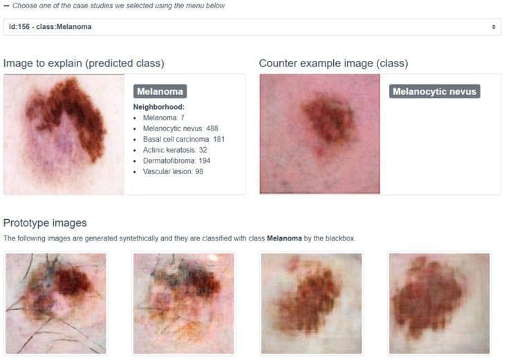 This Comparison Chart and Clinical Imaging infographic demonstrates a dermatological diagnostic interface for skin lesion classification. The top left 'Image to explain' displays a malignant melanoma characterized by the ABCDE criteria: asymmetry, highly irregular borders, and color variegation including shades of dark brown, black, and pink-violet. Beside it, a 'Counter example image' shows a melanocytic nevus, which exhibits more uniform pigmentation and relatively smoother, regular boundaries. The interface includes a 'Neighborhood' data panel listing distribution frequencies of similar latent representations among categories such as basal cell carcinoma and dermatofibroma. The lower section features four 'Prototype images'—synthetic exemplars generated by an Adversarial Autoencoder (AAE) to visually represent the core features of the melanoma class. This visual material is used in medical informatics to explain 'black box' machine learning decisions in dermatology, assisting students and clinicians in identifying high-risk morphological features that distinguish melanoma from benign melanocytic nevi.