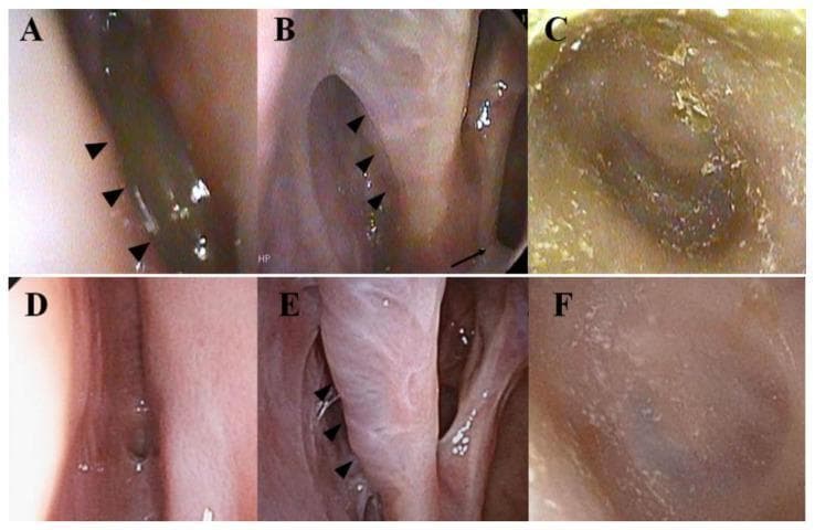 A comparison of endoscopic images from the nasal cavity and ear canal illustrating therapeutic response in a patient with eosinophilic chronic rhinosinusitis (ECRS) and eosinophilic otitis media (EOM). Panels A-C show findings after 13 months of mepolizumab (anti-IL-5) treatment. (A) Endoscopy of the left olfactory cleft reveals a persistent nasal polyp (arrowheads). (B) The nasal cavity and middle turbinate appear edematous, coated with a whitish exudate (arrowheads), with visible discharge from the maxillary sinus ostium (arrow). (C) Otoscopy shows the ear canal and eardrum obscured by copious dried exudate. Panels D-F show the same sites after 1 month of dupilumab (anti-IL-4Ṛ) treatment. (D) The olfactory cleft is clear with no polyps visible. (E) The nasal mucosa and middle turbinate (arrowhead) appear normal with resolution of inflammation and discharge. (F) The ear canal and eardrum have a normal, clear appearance. The series demonstrates the superior efficacy of dual IL-4/IL-13 inhibition over IL-5 inhibition in resolving inflammatory exudates and polyposis in this clinical scenario.