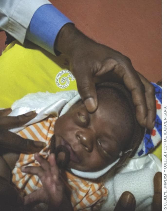 This clinical photograph shows an infant presenting with ophthalmia neonatorum, a form of neonatal conjunctivitis. The primary clinical signs include severe bilateral eyelid edema (swelling) and profuse, thick, purulent (pus-like) discharge emanating from the palpebral fissure. The discharge is thick and yellowish, characteristic of a hyperacute bacterial infection such as gonococcal conjunctivitis. An adult hand is shown gently retracting the upper eyelid to reveal the extent of the inflammation and ocular discharge. The infant is swaddled and using a pacifier, indicating a clinical examination setting. This image serves as a significant educational tool for recognizing the signs of neonatal eye infections, which require urgent diagnosis and treatment to prevent serious complications such as corneal ulceration, perforation, and permanent visual impairment. The anatomical focus is on the ocular and periorbital region, demonstrating the hallmark presentation of severe infectious conjunctivitis in the first weeks of life.
