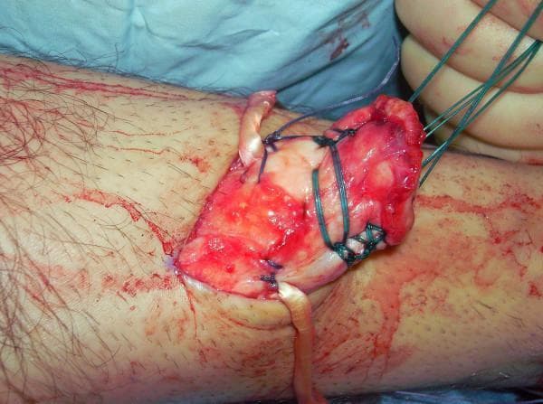 This clinical photograph captures an intraoperative view of an Achilles tendon (AT) reconstruction, specifically showing the integration of a semitendinosus tendon graft. The surgical site, located on a lower extremity, reveals an open longitudinal incision with exposed, erythematous, and fibrous connective tissue. A harvested semitendinosus tendon graft is being sutured to the substance of the proximal Achilles tendon stump. Multiple green monofilament and dark braided sutures are visible, used for tensioning and fixating the graft through a series of tenotomies. The surrounding skin shows surgical preparation with some hair removal and cutaneous blood staining. The image demonstrates a key stage in complex tendon repair, illustrating the surgical technique of using an autograft to bridge a large tendon defect or rupture. Visible features include the glistening white texture of the healthy tendon graft against the raw, hyperemic surgical field, as well as the precise placement of locking and tension sutures required for functional reconstruction.