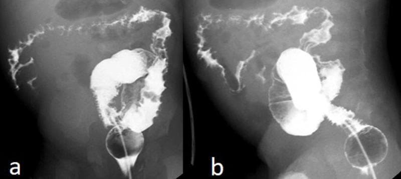 This diagnostic fluoroscopic image displays a barium enema examination of the colon in an infant, presented in two views (a and b). The primary findings include a significantly reduced caliber of the colonic lumen and a strikingly irregular mucosal contour. A classic radiological 'thumbprinting' sign is evident, characterized by rounded, smooth indentations along the colonic wall. These features represent submucosal edema, hemorrhage, or intraluminal masses, which in this clinical context correspond to gastrointestinal hemangiomatosis. The distribution of the pathology is extensive, involving the ascending, transverse, and descending segments of the colon, while the sigmoid colon appears relatively spared with a more preserved caliber. The image demonstrates key signs of diffuse inflammatory or vascular colonic disease, essential for pediatric radiology and gastroenterology education. The balloon of the enema catheter is visible in the rectum, marking the distal extent of the study.