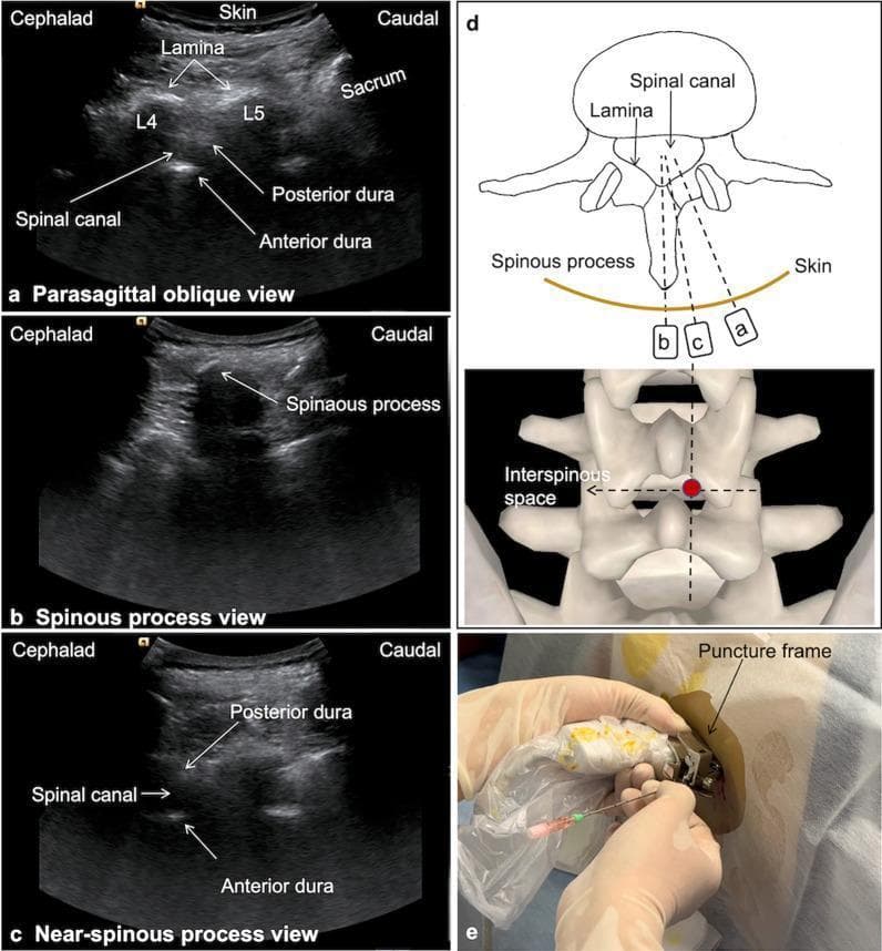 This composite educational graphic illustrates ultrasound-guided lumbar puncture techniques using various spinal scanning views. Panels (a), (b), and (c) present sagittal ultrasound images of the lumbar spine: (a) Parasagittal oblique view identifying the L4/L5 laminae, sacrum, and dural boundaries; (b) Spinous process view showing the characteristic acoustic shadow of the posterior bony elements; and (c) Near-spinous process view providing an optimized window for visualizing the spinal canal between the anterior and posterior dura. Panel (d) contains a transverse schematic diagram and a 3D anatomical model of the vertebrae, correlating the transducer angles (a, b, c) with the internal anatomy and marking the target puncture point in the interspinous space. Panel (e) is a clinical photograph demonstrating the procedural application: a sterile-covered convex probe with an attached needle guide frame is used for real-time guidance while a puncture needle is inserted. The content is designed for medical training in neuraxial anesthesia and spinal access procedures.