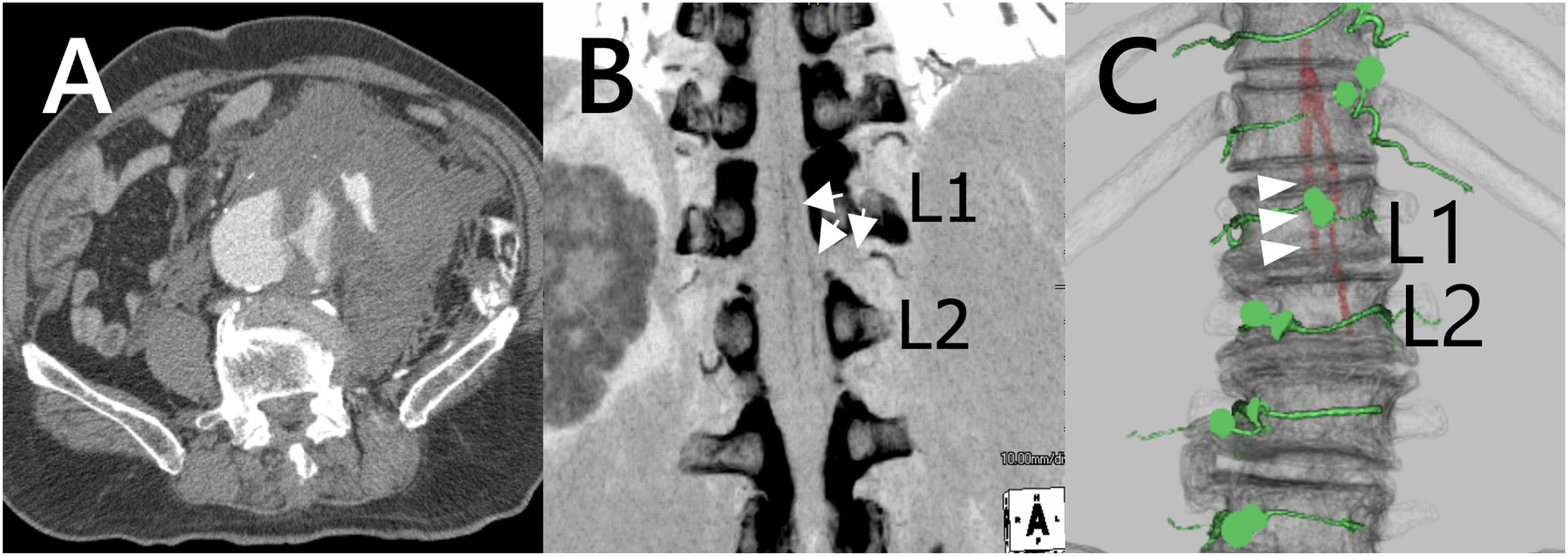 This composite of three diagnostic images illustrates a case of abdominal aortic aneurysm (AAA) and its vascular anatomy. Panel A is an axial contrast-enhanced computed tomography (CT) scan of the abdomen showing a large infrarenal abdominal aortic aneurysm with associated rupture, evidenced by a massive, high-attenuation retroperitoneal hematoma extending into the left flank. Panel B displays a coronal Maximum Intensity Projection (MIP) CT image focused on the spine, where white arrows identify the Artery of Adamkiewicz originating at the L1-L2 vertebral level. Panel C shows a three-dimensional (3D) CT reconstruction of the lumbar spine and vasculature, with the Adamkiewicz artery highlighted in green (marked by white arrowheads) and the aorta in red, providing a spatial representation of the vessel's origin and course relative to the bony anatomy. These images are clinically significant for preoperative planning in endovascular aneurysm repair (EVAR) to avoid spinal cord ischemia by identifying critical spinal blood supply.