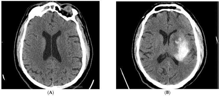 This figure presents a side-by-side comparison of non-contrast axial cerebral CT scans from the same patient, illustrating the progression of an acute stroke. (A) Initial CT scan at admission shows brain parenchyma with normal density and preserved grey-white matter differentiation. Symmetrical lateral ventricles and midline alignment are maintained, with no visible established ischemic lesions or hemorrhage at this early stage. (B) Follow-up CT scan performed 24 hours after thrombolytic therapy reveals a significant hemorrhagic transformation. A large, irregularly shaped hyperdense (bright) area is visible within the left hemisphere, specifically involving the left middle cerebral artery (MCA) territory. This hyperdensity indicates an intraparenchymal hematoma. There is evidence of mild mass effect on the adjacent left lateral ventricle. This comparison serves as a clinical example of a common complication following reperfusion therapy in acute ischemic stroke, emphasizing the importance of follow-up neuroimaging to detect secondary intracranial hemorrhage.