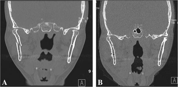 This diagnostic image consists of two side-by-side coronal CT scans (Figures A and B) of the maxillofacial region, focusing on a mandibular fracture and its subsequent surgical repair. Figure A demonstrates a displaced subcondylar fracture of the right mandible. The fracture line is clearly visible, showing medial displacement of the condylar fragment with the condylar head tilted laterally, creating a significant loss of anatomical continuity at the mandibular neck. Figure B shows the postoperative result following open reduction and internal fixation (ORIF). A radiopaque titanium miniplate is seen spanning the previous fracture site on the right subcondylar region, secured with multiple radiopaque screws. The anatomical alignment of the right mandibular condyle has been restored, with the condylar head now correctly seated within the glenoid fossa. These images illustrate the preoperative pathology of a displaced mandibular fracture and the efficacy of internal fixation using a miniplate via a surgical approach such as the Risdon approach.