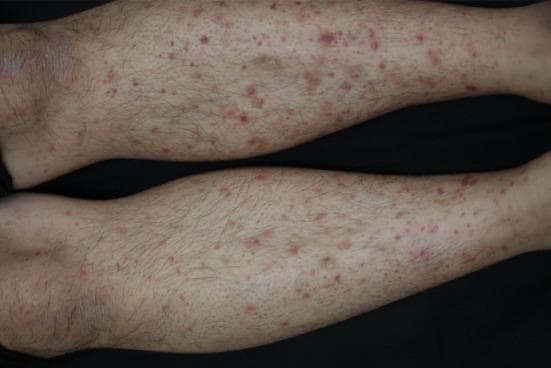 This clinical photograph shows a bilateral, symmetrical purpuric rash on the lower extremities of a patient. The lesions are non-blanching, reddish-purple macules and small papules, consistent with palpable purpura. They vary in size from pinpoint petechiae to several millimeters in diameter. The distribution is widespread across the shins and calves, with a tendency toward coalescence in certain areas. The surrounding skin appears otherwise normal in texture without obvious edema, ulceration, or secondary scaling. This presentation is characteristic of small-vessel vasculitis, specifically anaphylactoid purpura (Henoch-Schönlein purpura), which often presents with cutaneous involvement following a dependent distribution. The educational focus is on the morphological identification of vasculitic skin lesions and their clinical association with systemic conditions such as IgA nephropathy.