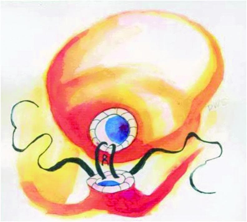 This medical illustration depicts a laparoscopic urethrovesical anastomosis, specifically the single-knot Van Velthoven technique used during robotic-assisted radical prostatectomy (RARP). The diagram shows the bladder as a large, globular superior structure and the urethra as a smaller inferior structure. A running suture technique is illustrated, showing the continuous passage of suture material through the full thickness of the bladder neck and the urethral stump. The visual emphasizes the spatial relationship between the two structures as they are being cinched together to create a watertight seal. The illustration highlights the posterior aspect of the anastomosis, demonstrating multiple consecutive suture loops that provide structural support and facilitate the reconstruction of the urinary tract. This content is intended for surgical education, focusing on urological reconstruction and laparoscopic suturing techniques.