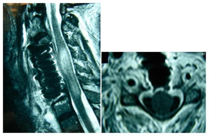 Postoperative magnetic resonance imaging (MRI) of the cervical spine in sagittal and axial views, demonstrating a multilevel anterior decompression and fusion. The sagittal view (left) reveals a titanium mesh cage positioned within the anterior column, replacing several vertebral bodies (corpectomy) to provide structural support. The spinal cord shows an area of intramedullary T2-hyperintensity and fusiform dilation, consistent with edema or syrinx formation following decompression for an infectious process such as spondylodiscitis. The axial view (right) shows the cross-sectional anatomy of the spinal canal with the spinal cord centrally located, exhibiting an altered morphology. Surrounding soft tissues and vascular structures are visible. This diagnostic imaging serves as an educational example of postoperative monitoring in complex spinal reconstructive surgery, highlighting the placement of metallic hardware and the subsequent radiological changes in the spinal cord parenchyma.