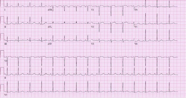 This diagnostic image is a 12-lead electrocardiogram (ECG) displayed in a standard format with three rhythm strips (V1, II, and V5) at the bottom. The tracing demonstrates a normal sinus rhythm following pharmacological cardioversion with flecainide. Key visual features include visible P waves preceding every QRS complex with a consistent PR interval. The QRS complexes are narrow (<120 ms), and the QRS axis is normal, characterized by positive deflections in leads I and aVF. T-wave morphology appears appropriate without acute ST-segment elevations or depressions. In the precordial leads, there is normal R-wave progression from V1 to V6. This tracing is clinically significant in a cardiology context for verifying the restoration of sinus rhythm and monitoring the effects of Class IC antiarrhythmic therapy, such as changes in the QRS duration or PR interval. The ECG reflects stable cardiac electrical activity in a patient previously treated for atrial tachycardia.