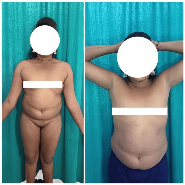Two clinical photographs show the anterior trunk of a female patient, illustrating characteristic physical features of Turner syndrome (45,XO). The images demonstrate a broad, shield-shaped chest (pectus excavatum/carinatum tendency) with widely spaced (hyperteloric) nipples. The patient exhibits a webbed neck (pterygium colli), where folds of skin extend from the mastoid process to the acromion. The photographs also depict short stature and a lack of secondary sexual characteristic development consistent with primary amenorrhea and ovarian dysgenesis. These visual findings serve as clinical markers for genetic screening in reproductive medicine and endocrinology. Patient identity is protected by facial masking.