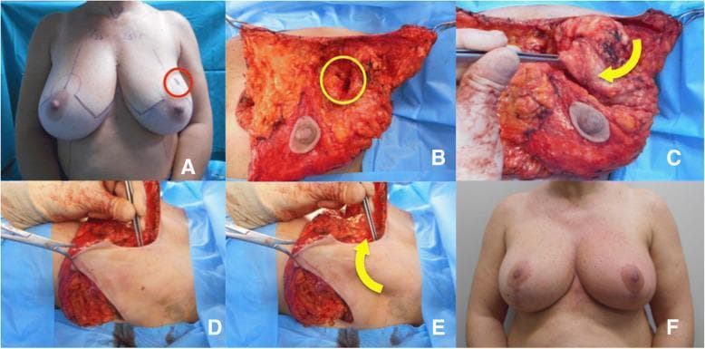 A series of clinical photographs documenting an oncoplastic breast surgery involving a wide local excision and axillary flap reconstruction for a tumor in the upper-outer quadrant. Image A (pre-operative) shows topographical markings on both breasts with a red circle indicating the lesion site. Image B (intra-operative) displays the exposed breast parenchyma after skin undermining, with a yellow circle highlighting the tumor bed defect down to the pectoralis fascia. Images C, D, and E demonstrate the mobilization and rotation of an axillary tissue flap into the excision site to restore volume; yellow arrows indicate the direction of flap transposition. Image F (post-operative, one year) illustrates the long-term aesthetic outcome, showing preserved breast symmetry, nipple-areola complex positioning, and successful volume replacement in the upper-outer quadrant. This sequence serves as an educational resource for surgical oncology and plastic surgery, demonstrating flap-based volume replacement techniques used to prevent post-lumpectomy deformity.