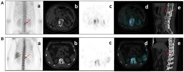 This diagnostic imaging set presents a comparison between malignant bone metastasis (A) and a benign bone lesion (B) in the spine, utilizing multiple modalities: (a) Planar scintigraphy (99mTc-MDP), (b) axial CT, (c) axial SPECT, (d) fused SPECT/CT, and (e) sagittal CT. Case A involves a 76-year-old male with prostate cancer, showing a nodular high-density (sclerotic) shadow on the right inferior aspect of the L2 vertebral body. This lesion correlates with intense, focal radiopharmaceutical uptake (hot spot) on SPECT/CT, characteristic of osteoblastic metastasis. Case B involves a 60-year-old male, showing a similar nodular sclerotic density at the superior aspect of the T12 vertebral body with increased tracer distribution. However, this was clinically confirmed as a benign lesion. The comparison highlights the diagnostic challenge in differentiating isolated sclerotic spinal lesions in oncological patients. The educational focus is on the integration of morphological CT data with functional SPECT data to evaluate metabolic activity in suspected skeletal metastases, emphasizing that focal uptake alone requires careful correlation with clinical history and follow-up imaging.