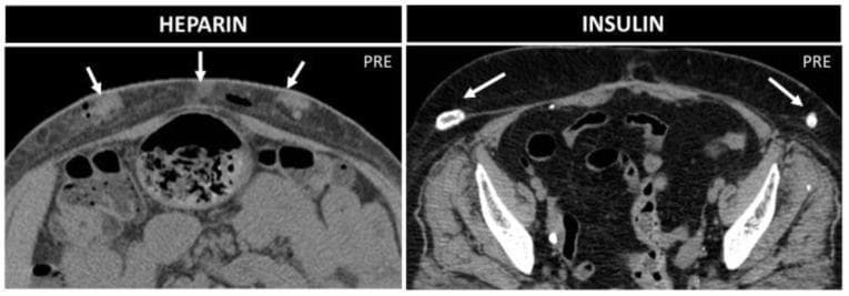 This figure presents a side-by-side comparison of axial non-enhanced CT images of the abdominal wall, illustrating complications from different subcutaneous injection types. The left panel (labeled 'HEPARIN') demonstrates multiple subcutaneous collections characterized by parenchymatous density, consistent with localized hematomas or bleeding resulting from repeated heparin injections. Within these soft-tissue nodules, small punctate air bubbles are visible. The right panel (labeled 'INSULIN') illustrates insulin-induced lipohypertrophy. These lesions appear as focal, heterogeneous subcutaneous masses that prominently feature dense peripheral calcifications (white arrows). The comparison highlights the different imaging signatures of injection-related sequelae: hemorrhagic collections and air pockets associated with anticoagulants versus calcified fatty proliferation (lipodystrophy) associated with chronic insulin therapy. Both images provide a cross-sectional view of the anterior abdominal wall at the level of the pelvis and mid-abdomen, emphasizing the clinical importance of recognizing benign injection-related findings that may mimic more serious abdominal wall pathology.