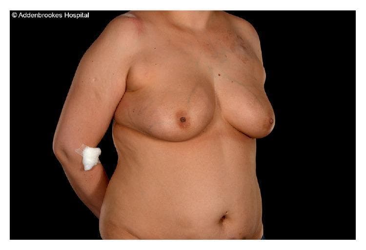 Clinical photograph of a 37-year-old female patient's torso, illustrating preoperative findings before a right mastectomy and DIEP (Deep Inferior Epigastric Perforator) flap reconstruction. The image focuses on the abdomen and chest. Extensive ecchymosis (bruising) is visible across the bilateral lower abdomen, characterized by irregular patches of purple and blue discoloration. These lesions are consistent with subcutaneous heparin or enoxaparin injection sites, commonly used for perioperative thromboprophylaxis. The upper torso shows the right breast area prepared for surgical intervention, with visible skin changes and subtle scarring in the infraclavicular region. A medical dressing is present on the right antecubital fossa, likely covering an intravenous access site. This photograph serves as an educational example of the local dermatological effects of anticoagulation therapy in patients undergoing complex reconstructive surgery.